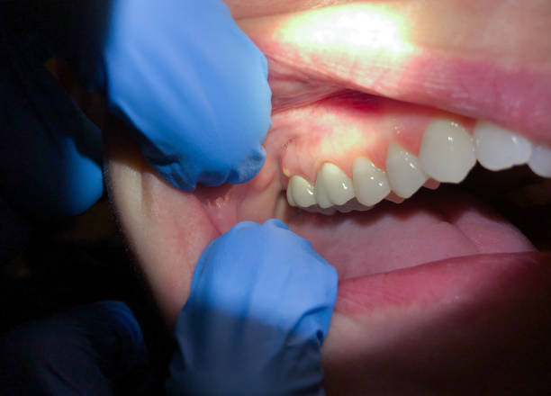 Best Root Canal Emergency Dentist  in Wyncote, PA